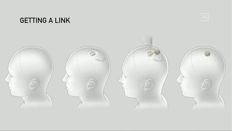 neuralink-implant-3.jpg
