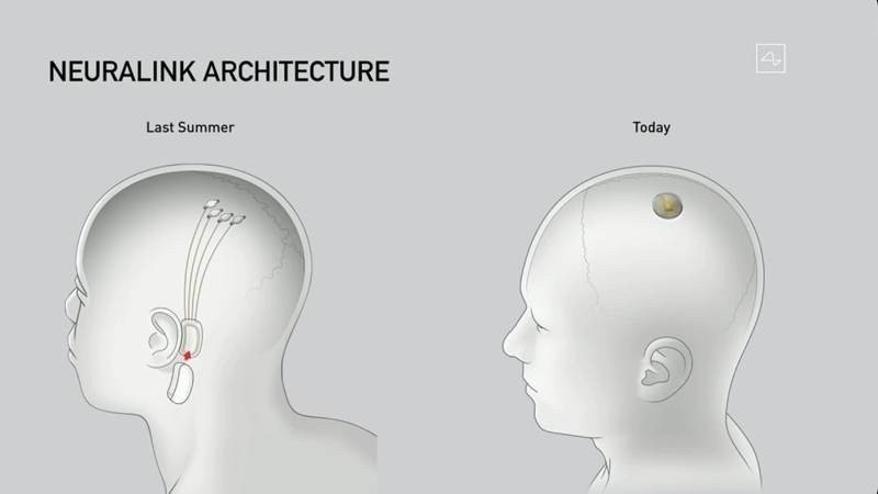 neuralink-implant.jpg