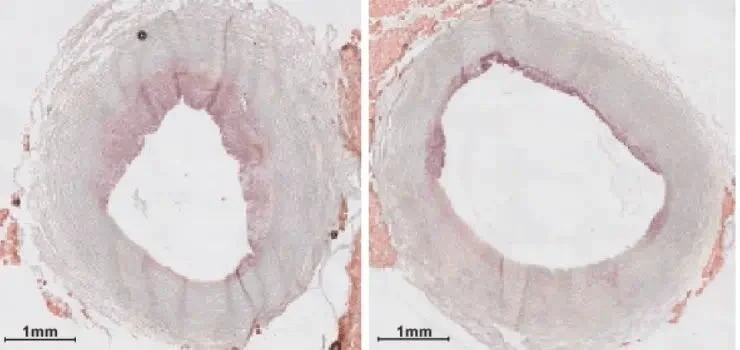 nanoparticles-atherosclerosis.jpg nanoparticles-atherosclerosis.jpg